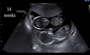 14 Weeks Twins