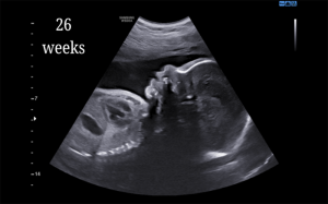 26 Weeks